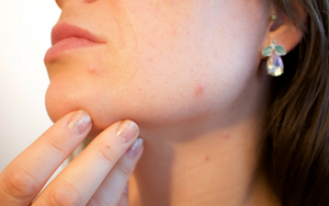How Stress Can Affect Your Skin? A Dermatologist Explains It